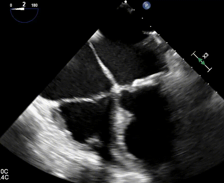TEE preview: severely depressed LV and RV function